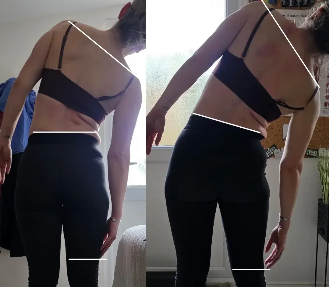 Before and after photographs show a client’s standing alignment